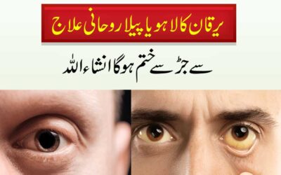 Kale Aur Peele Yarkan Ka Ilaj
